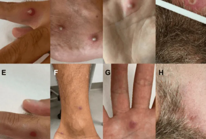 Brasil registrou 88 casos confirmados do vírus Mpox em 2026